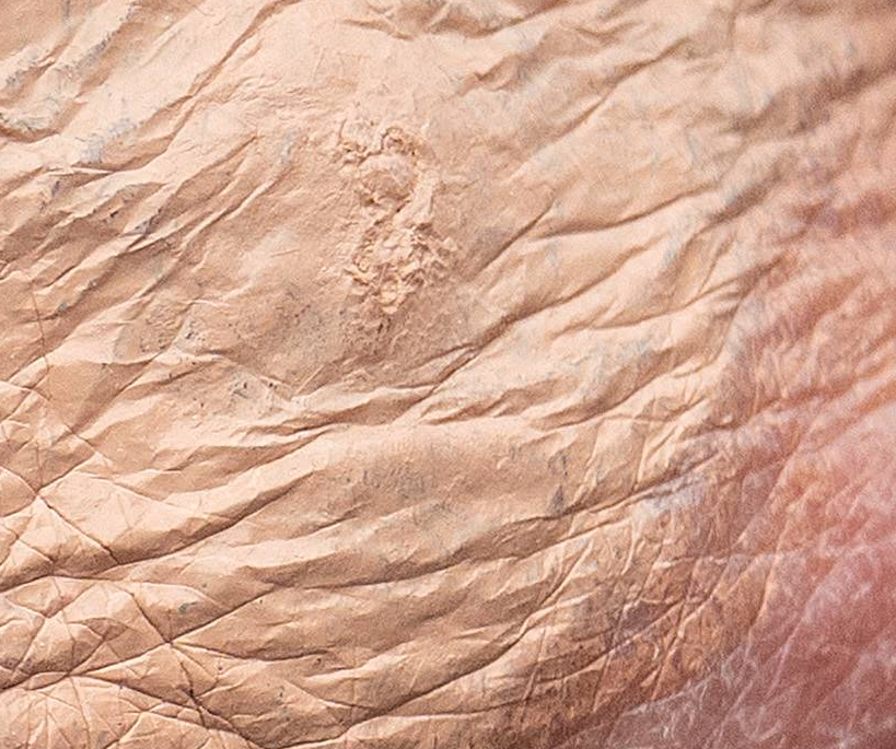 One part of Trump's hand appeared to have a raised scar