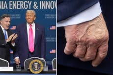 Trump comes clean after questions raised about his swollen ankles and bruised hand