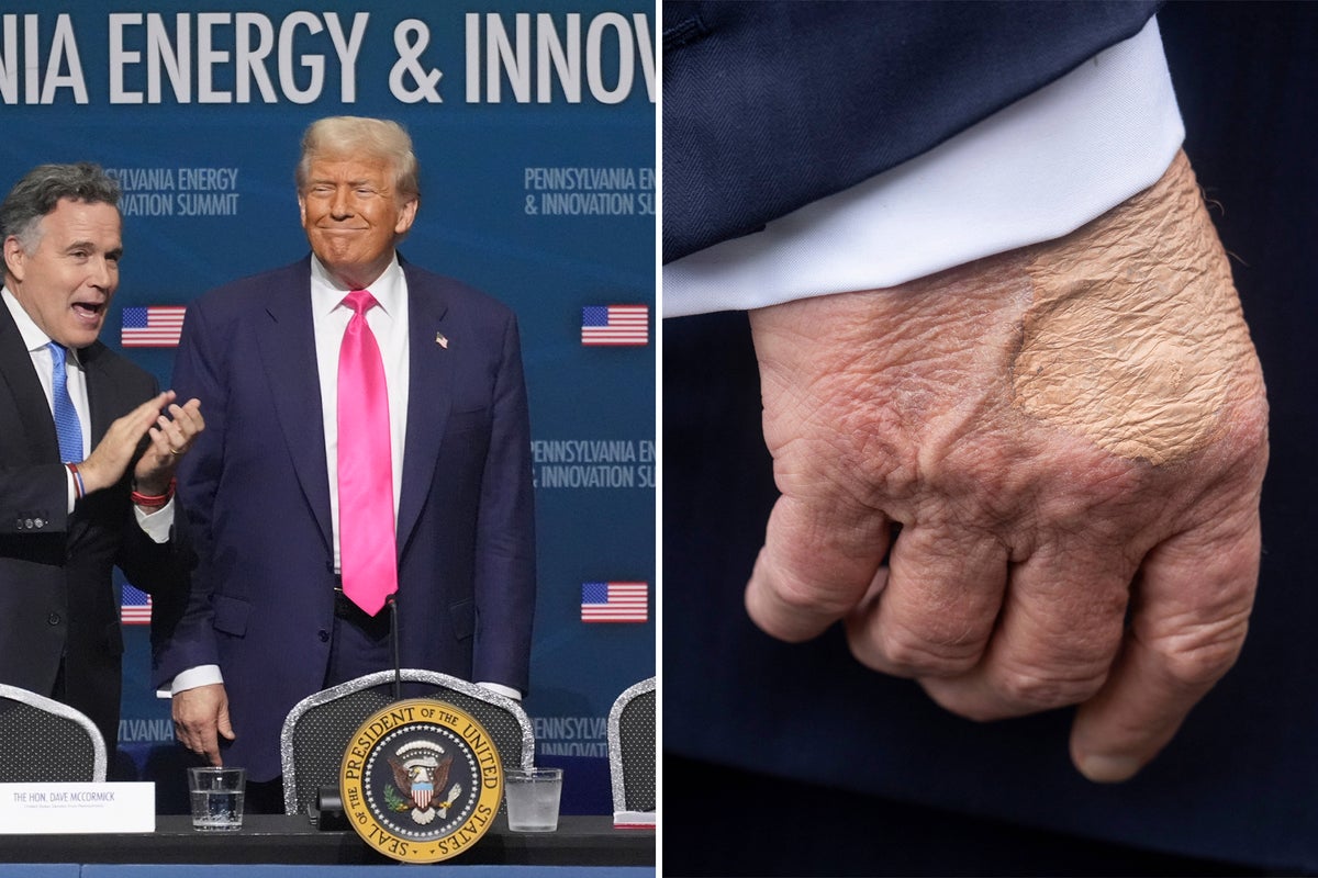 Trump’s strange bruised hand makes reappearance before president’s visit to Pittsburgh Trump’s strange bruised hand makes reappearance before president’s visit to Pittsburgh