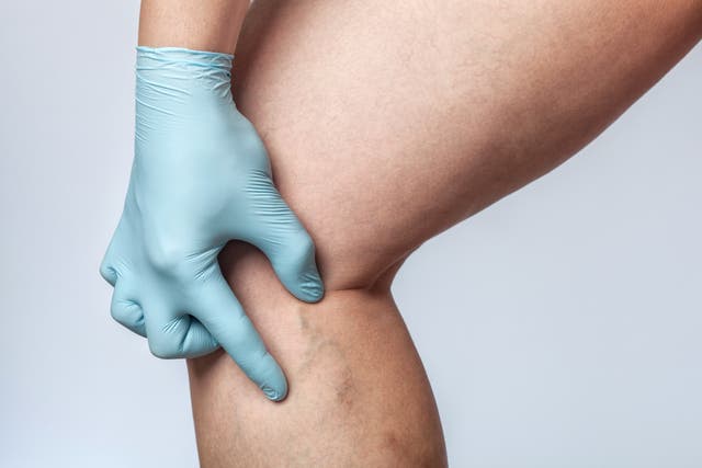 <p>If left untreated, chronic venous insufficiency may result in varicose veins, leg ulcers, and other symptoms. </p>