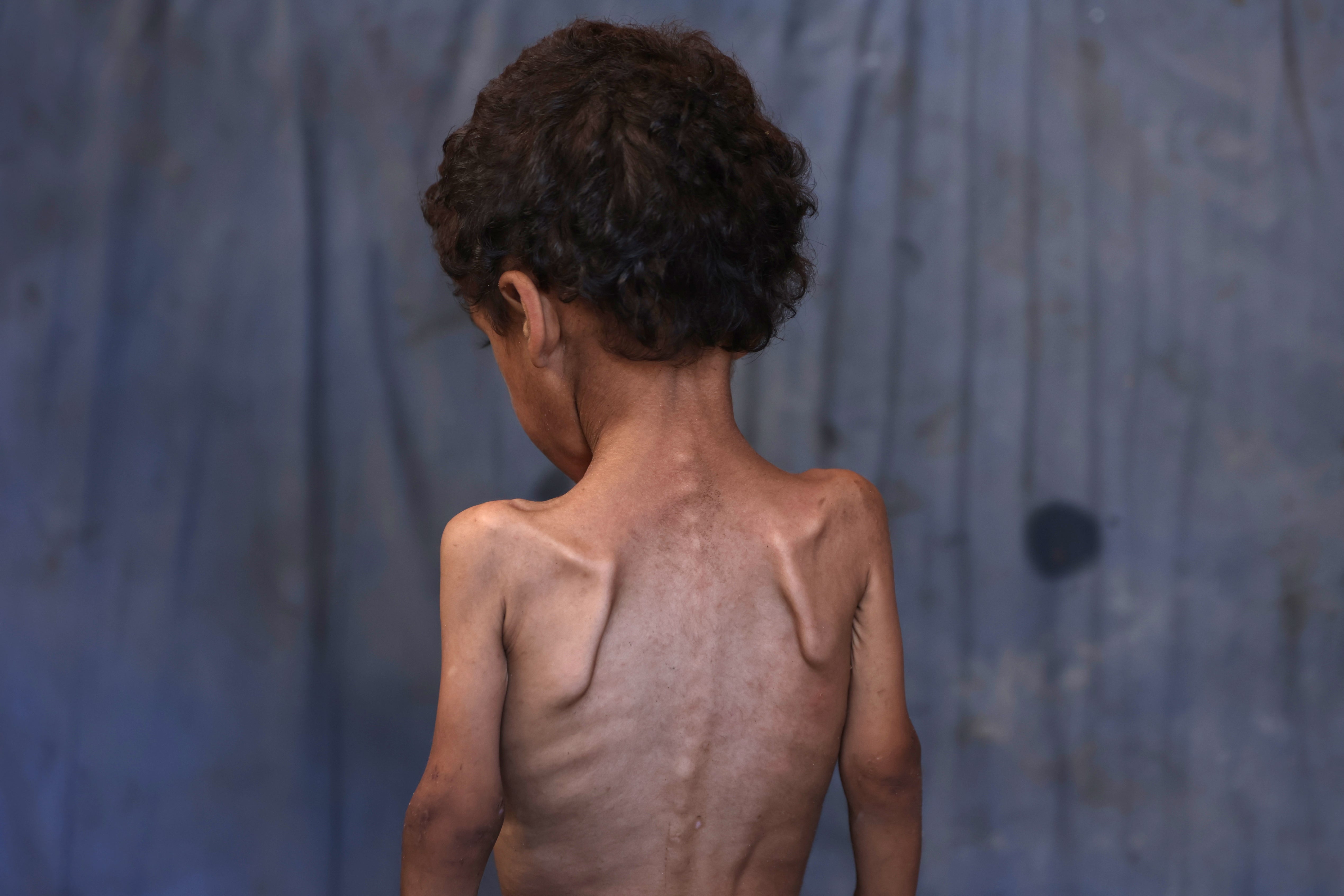 Yazan, a malnourished 2-year-old Palestinian boy, stands in his family’s damaged home in al-Shati refugee camp, west of Gaza City