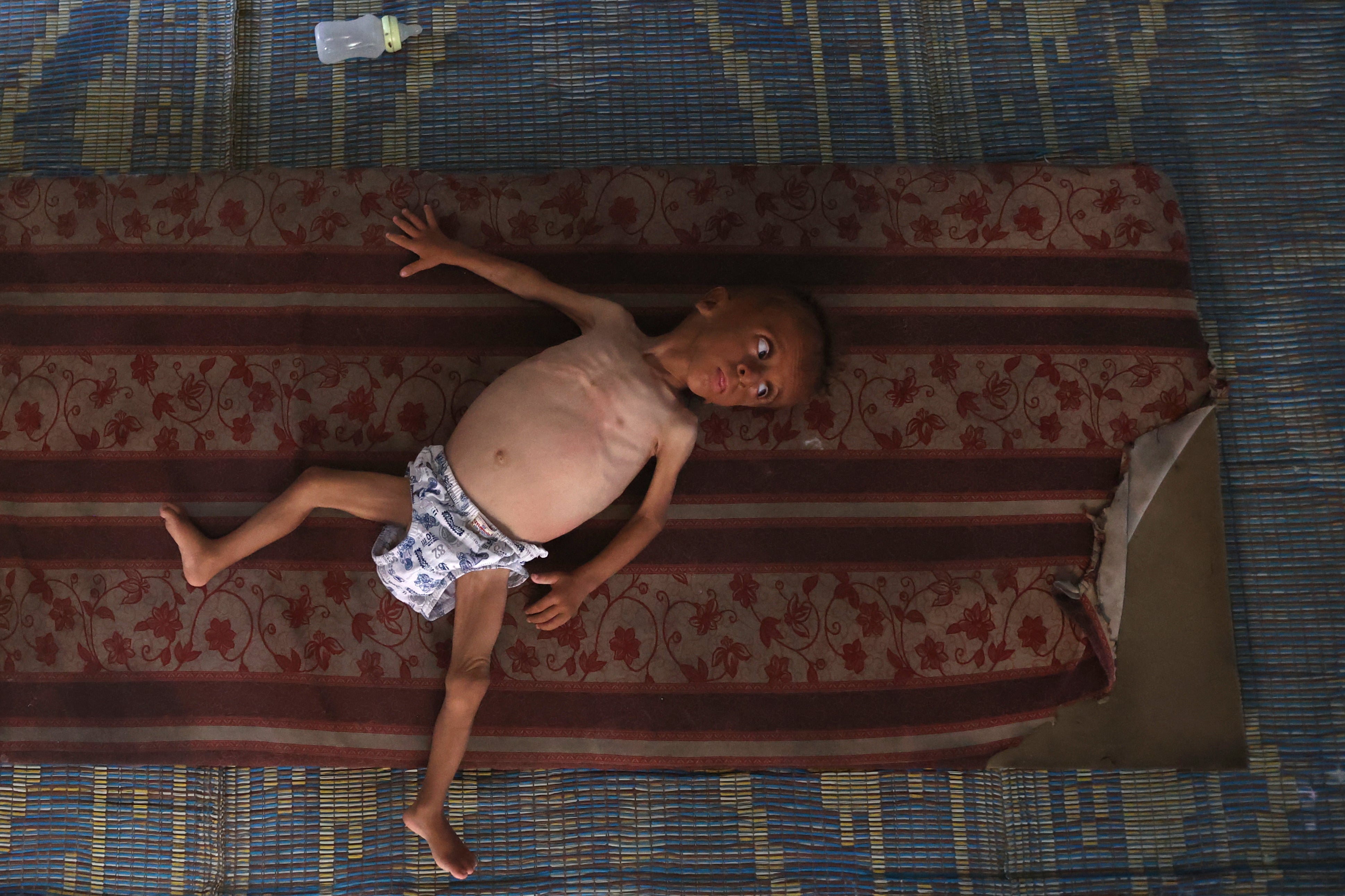Mohammed al-Mutawaq, an 18-month-old Palestinian boy suffering from medical issues and displaying signs of malnutrition, lies inside a tent in the Al-Shati refugee camp in Gaza City on 24 July 2025