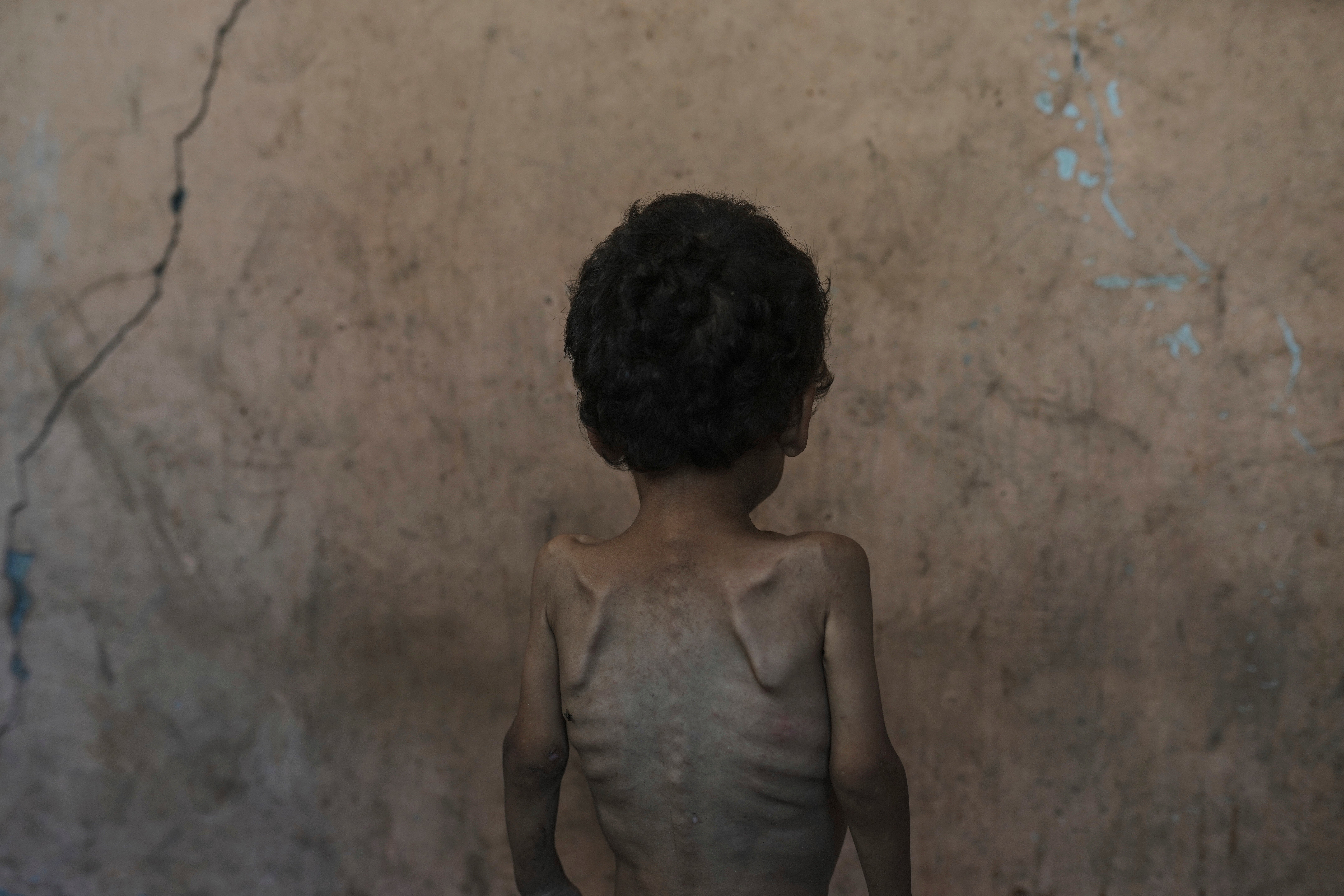 Yazan Abu Ful, a 2-year-old malnourished child, poses for a photo at his family home in the Shati refugee camp, in Gaza City