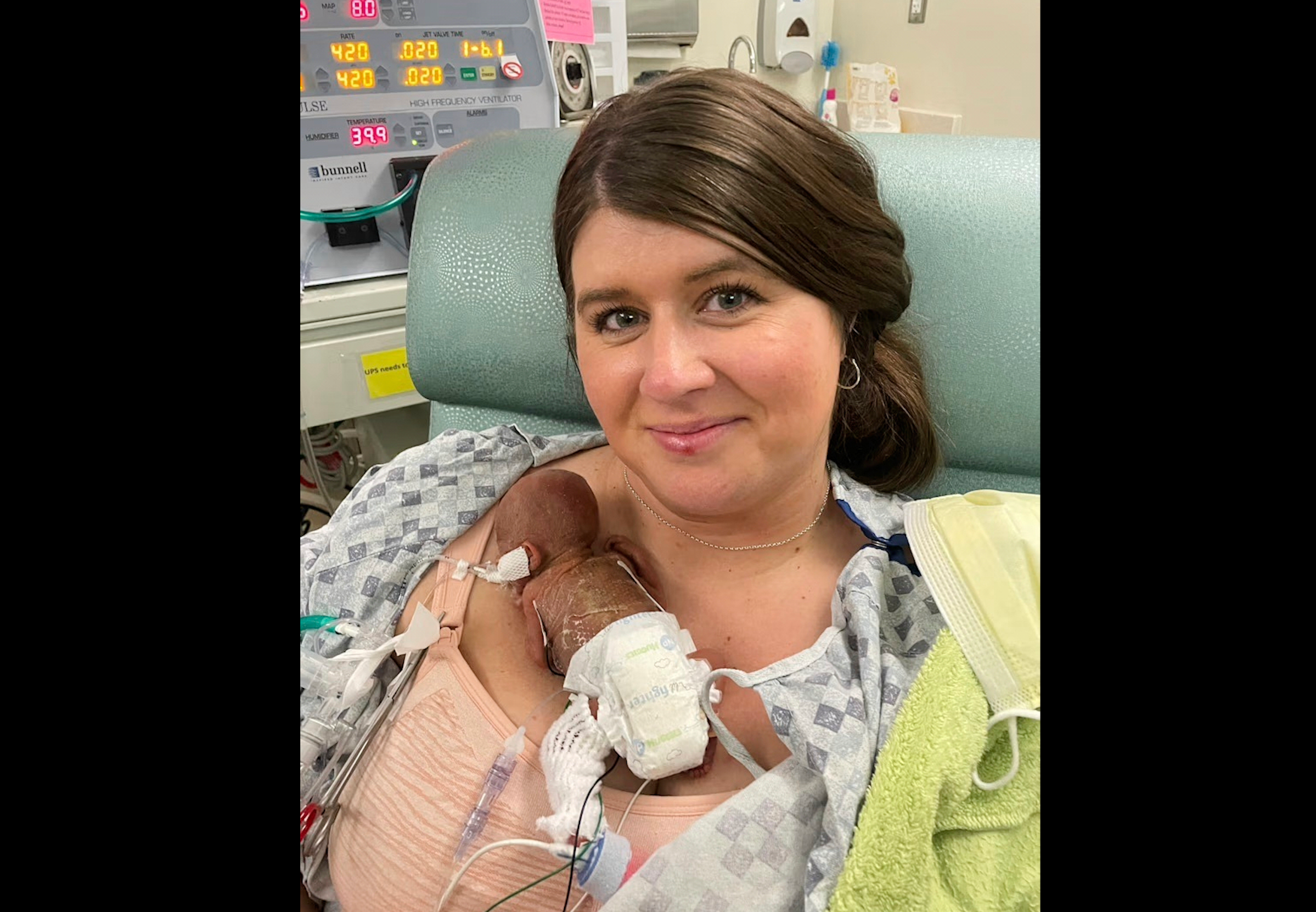 After becoming pregnant with Nash, the Keens learned at Mollieโs 20-week prenatal checkup that she was already two centimeters dilated. Doctors don't typically try to perform lifesaving measures for babies born before 22 weeks gestation as most born that young can't survive