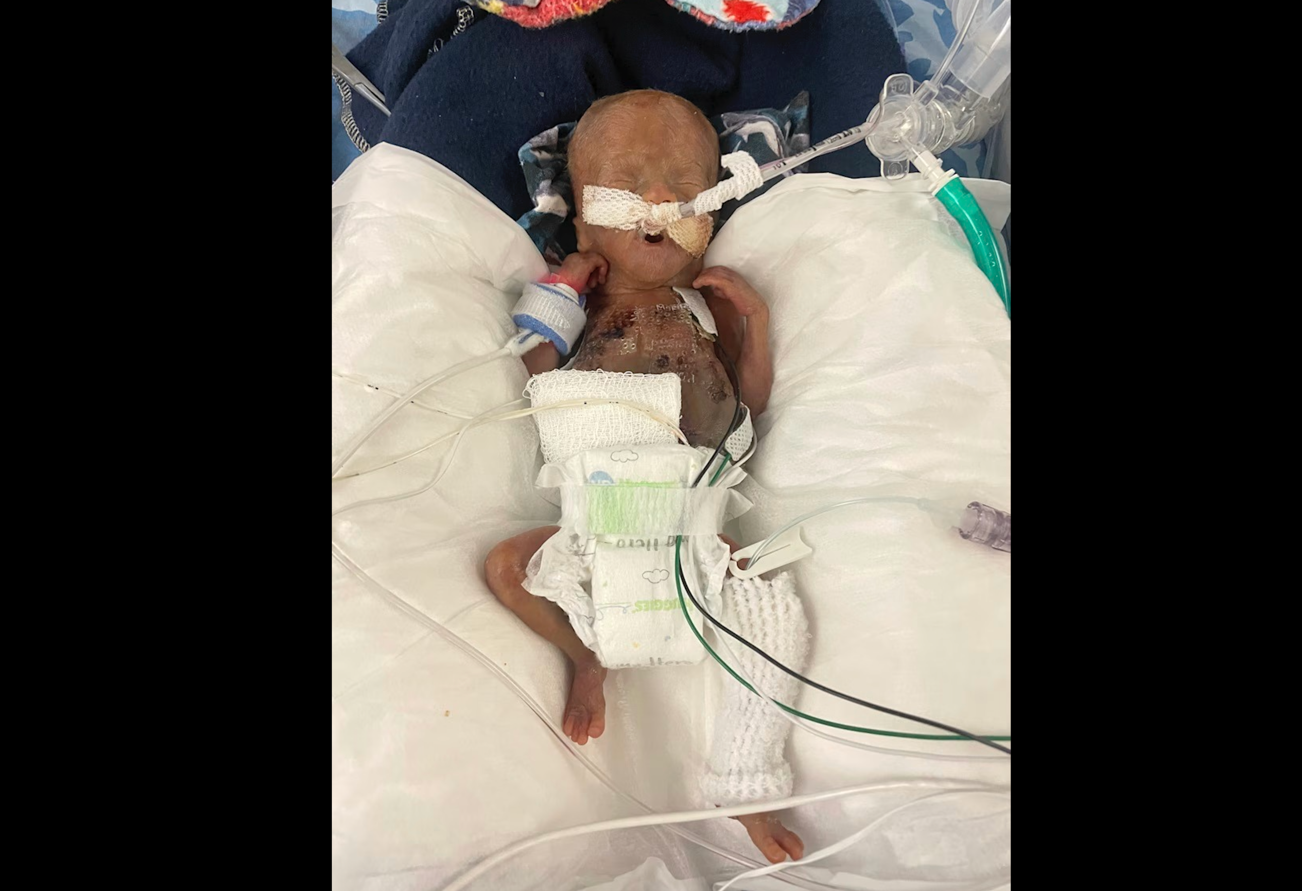 A little boy born at only 21 weeks of gestation has officially broken the record for the worldโs most premature baby. Nash Keen was born in Iowa City, Iowa, on July 5, 2024 โ 133 days earlier than the expected due date and weighing only 10 ounces