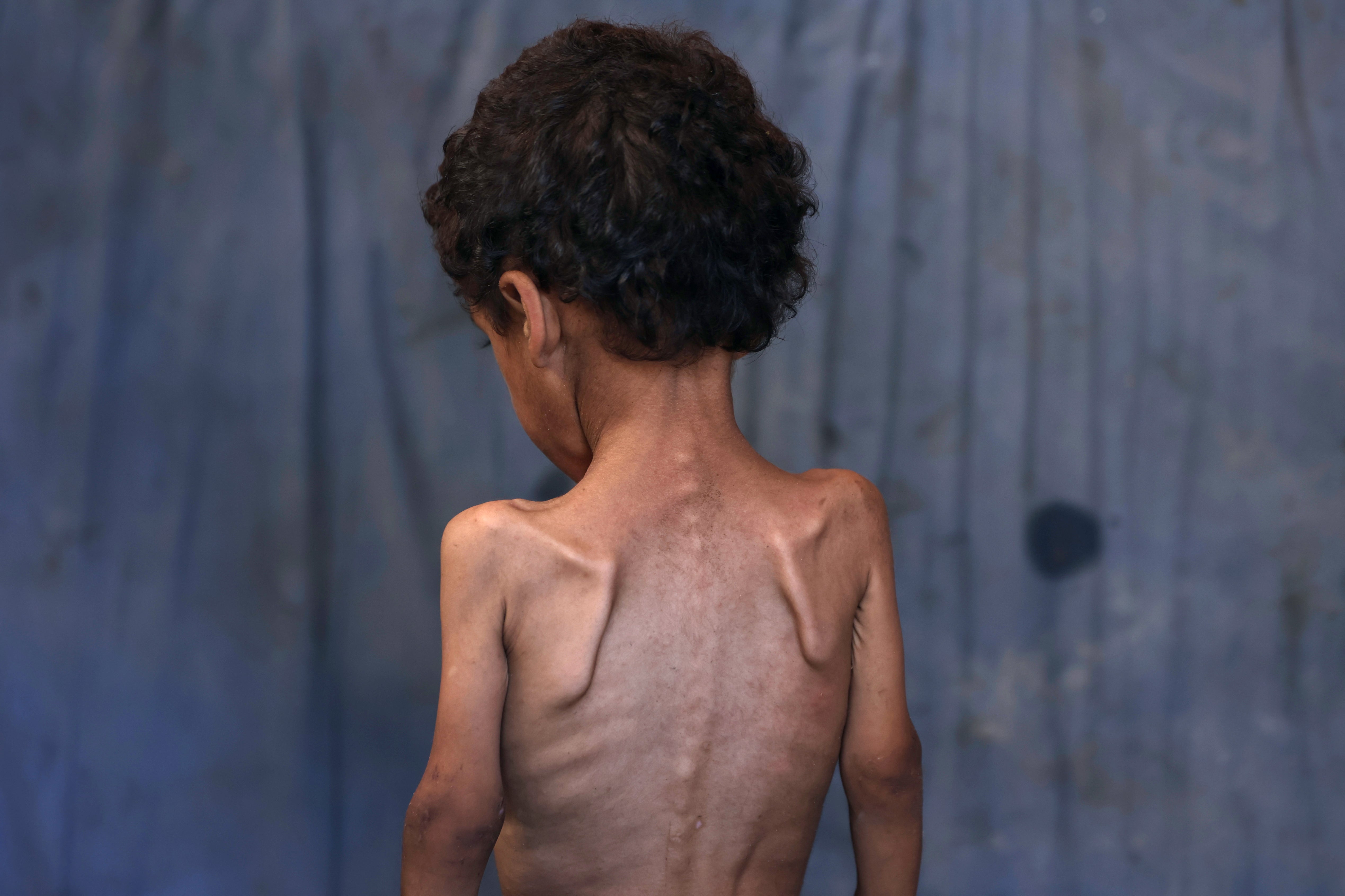 Yazan, a malnourished 2-year-old Palestinian boy, stands with his back turned in his family's damaged home in the Al-Shati refugee camp, west of Gaza City