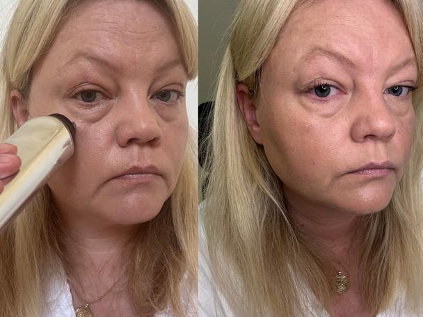 CurrentBody skin RF microneedling treatment