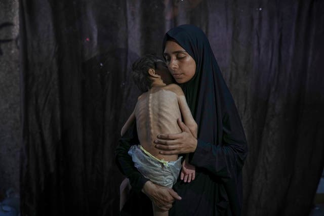 ‘Shockingly high’ number of Gaza children hospitalized with acute ...