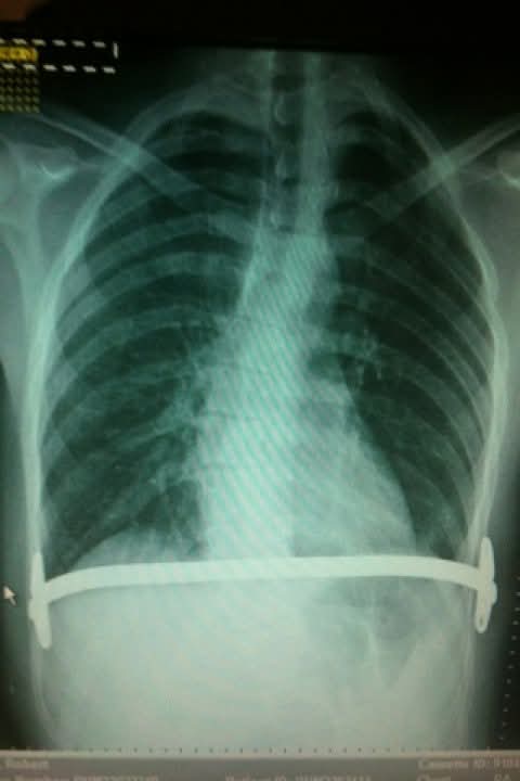 Pactus excavation in severe cases may require surgery where once the space inside the chest is painted on Sri Lindsel.