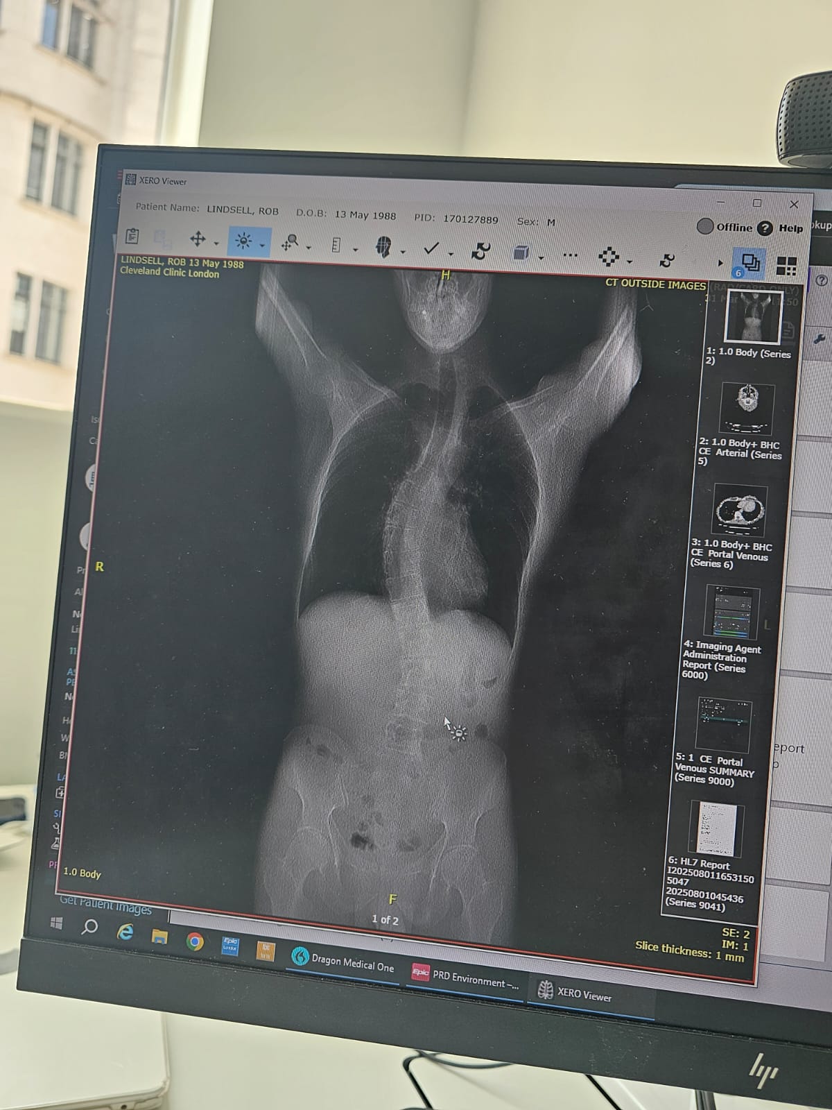 Rob Lindsel had an X-ray in a private clinic, which revealed that he has not only a hernia, but its spine has deteriorated.