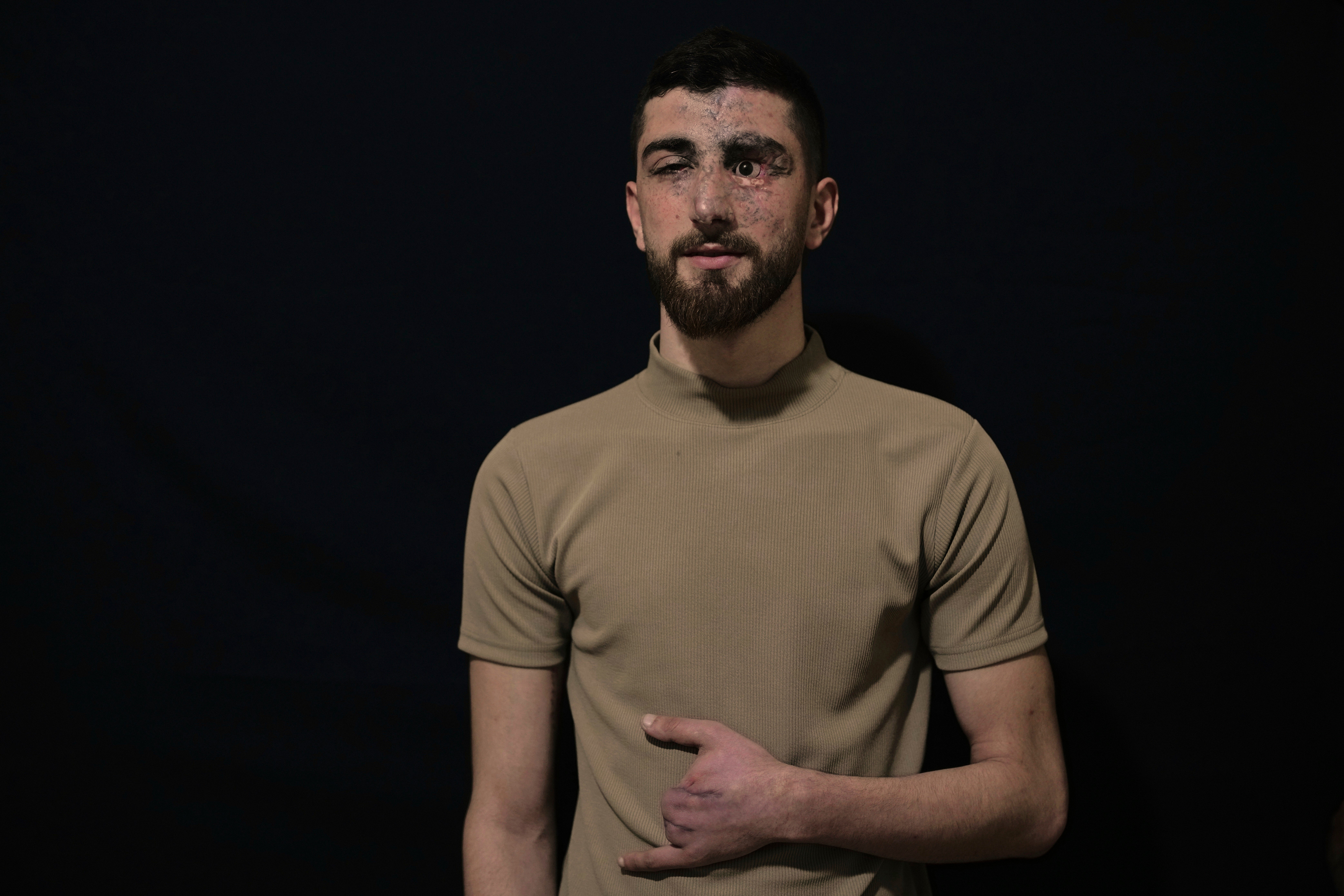 Lebanon Pager Attack Survivors Photo Essay