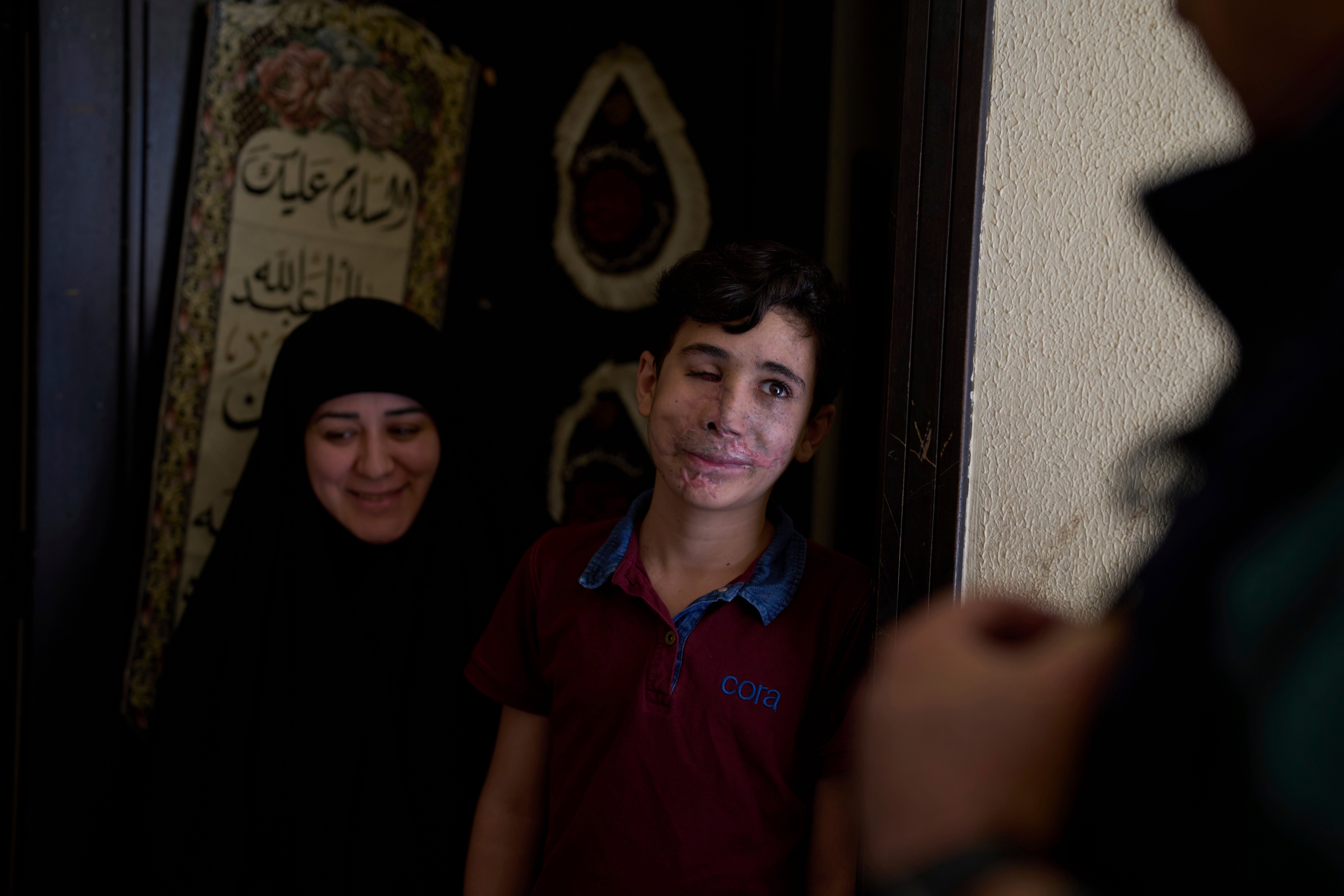 Mideast Wars Lebanon Pager Attack Survivors