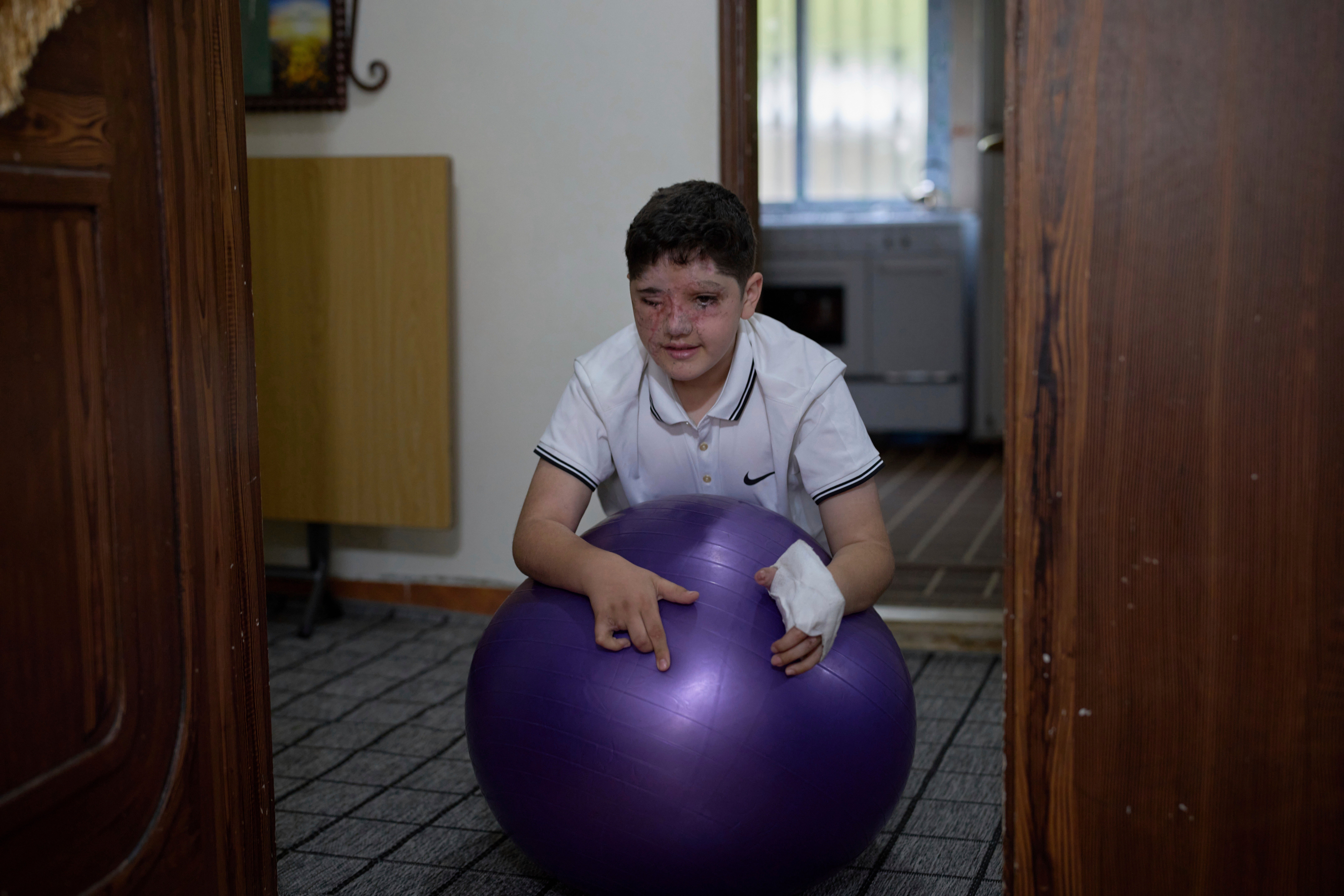 LIBANO-HEZBOLLAH-EXPLOSIONES BÍPERS-SOBREVIVIENTES