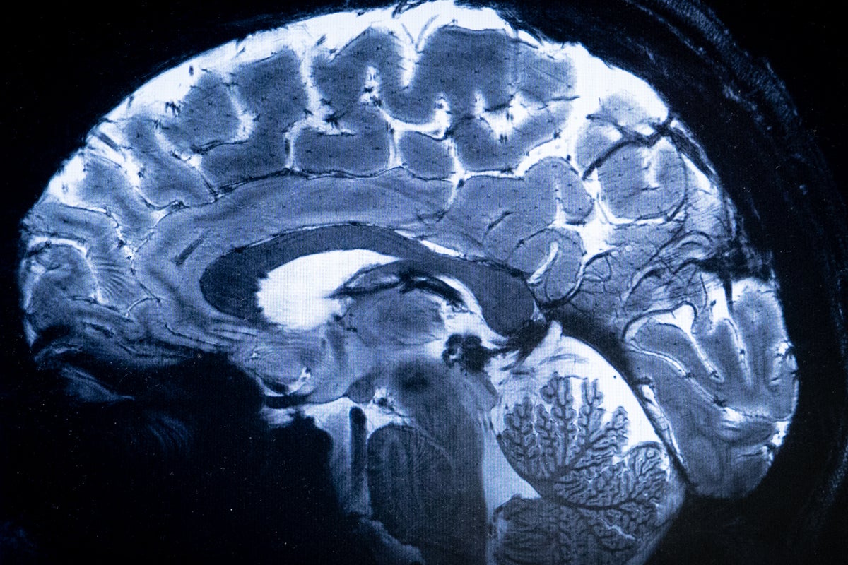 Breakthrough study finds Alzheimer’s could be due to this deficiency