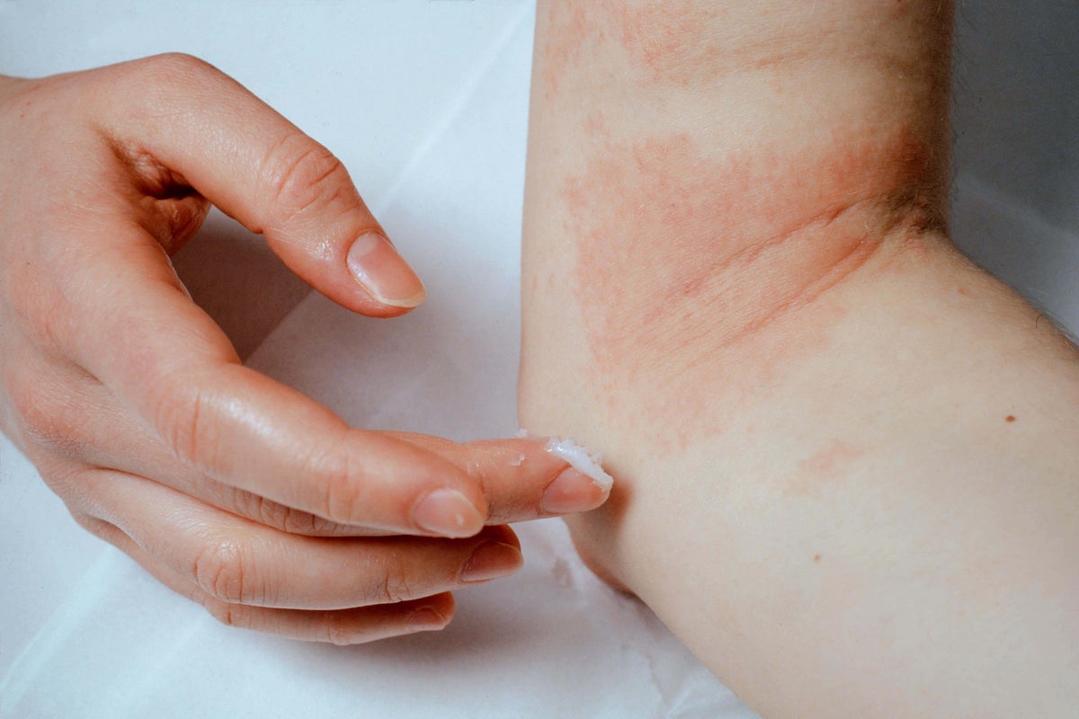 Best psoriasis-friendly skincare routine