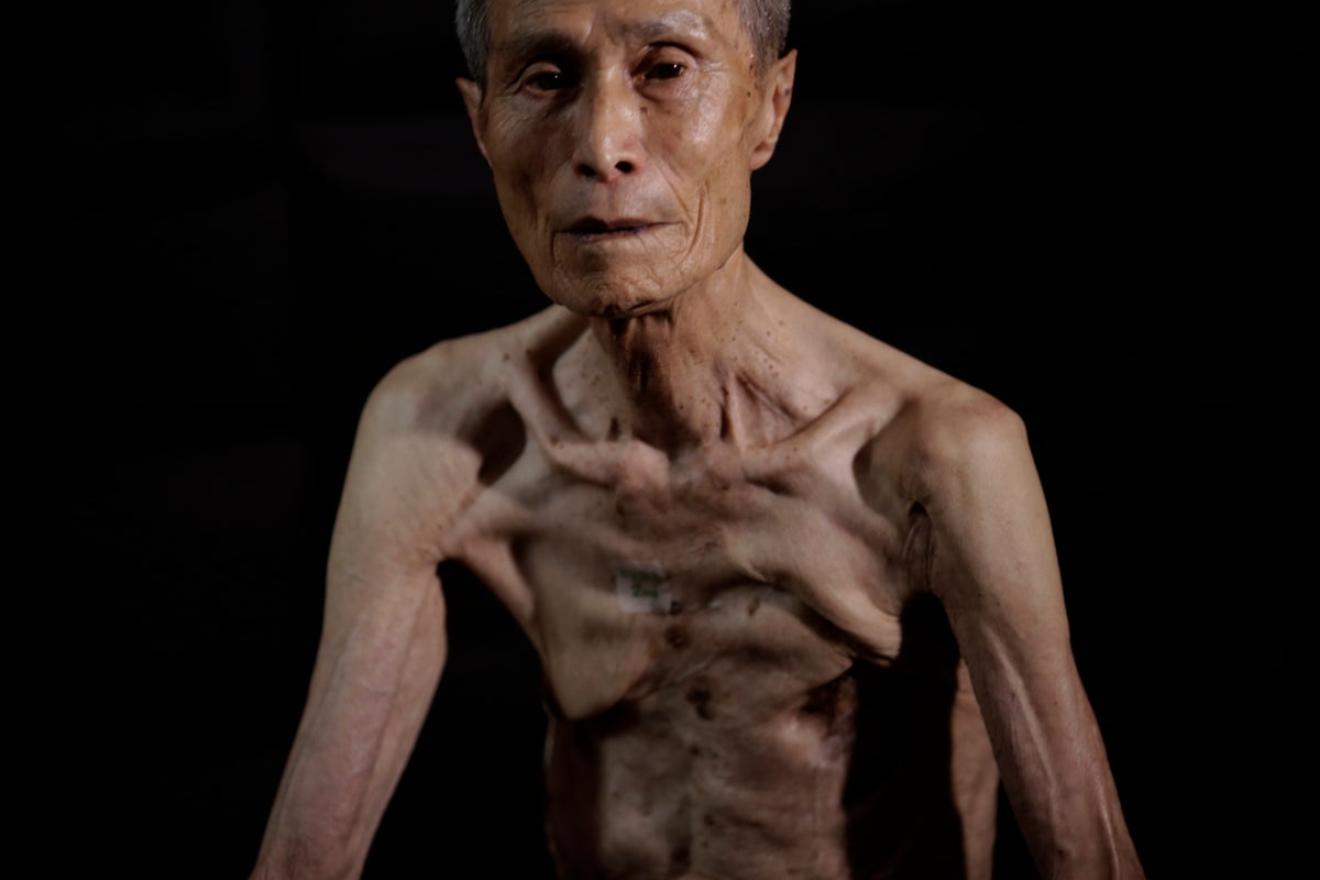 Powerful AP photos show the scars of a survivor of the Nagasaki atomic bombing