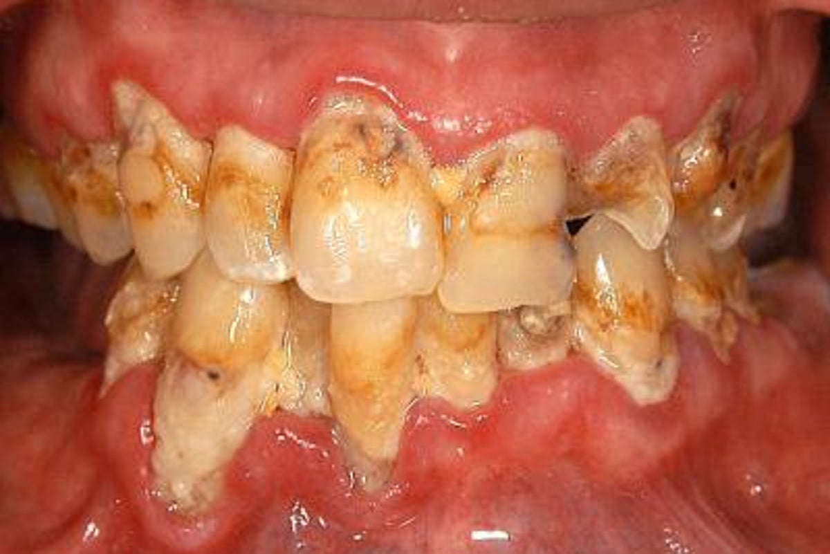 These vegetables have a natural compound that could lead to new plaque-destroying toothpastes