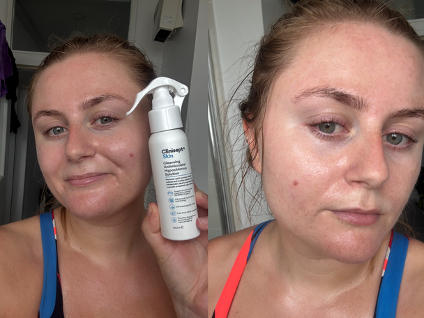 Indybest best hypochlorous acid spray review Clinisept+ skin cleansing antimicrobial hypochlorous solution