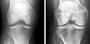 Simple walking style change may help delay knee surgery for years