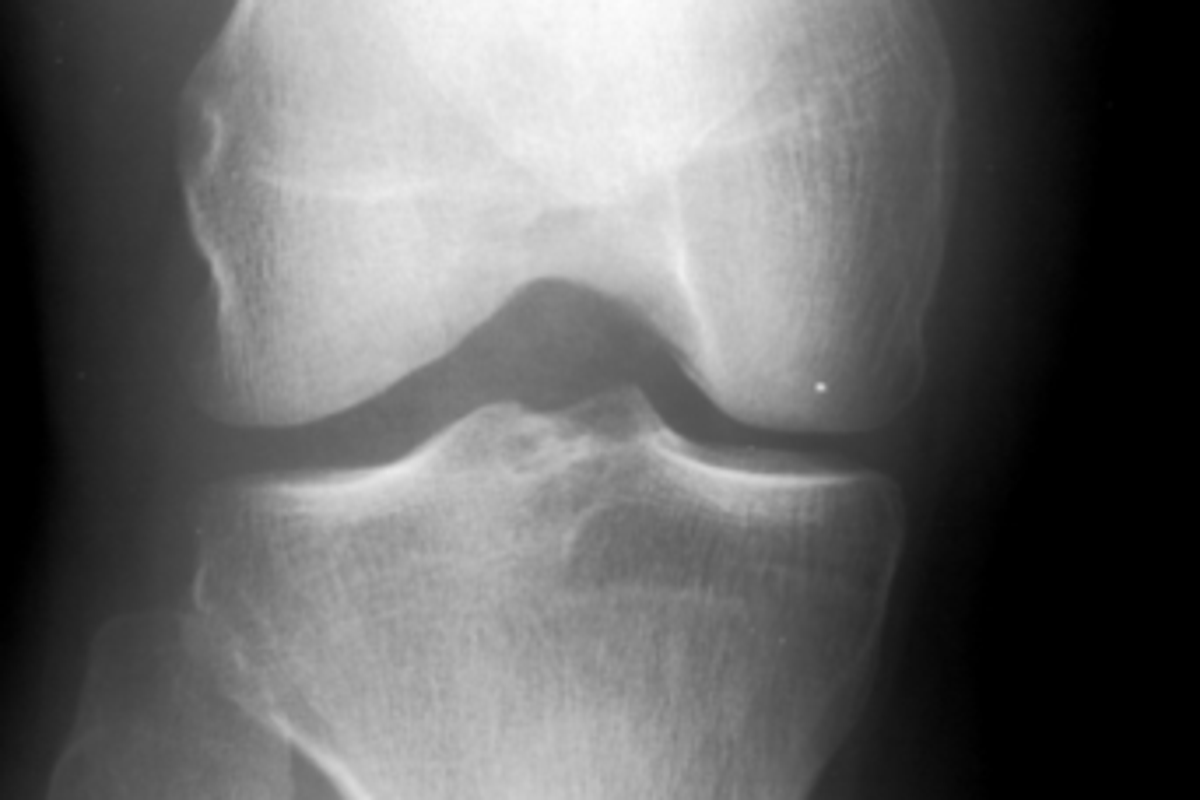 This small walking style change can delay knee surgery for years, study finds