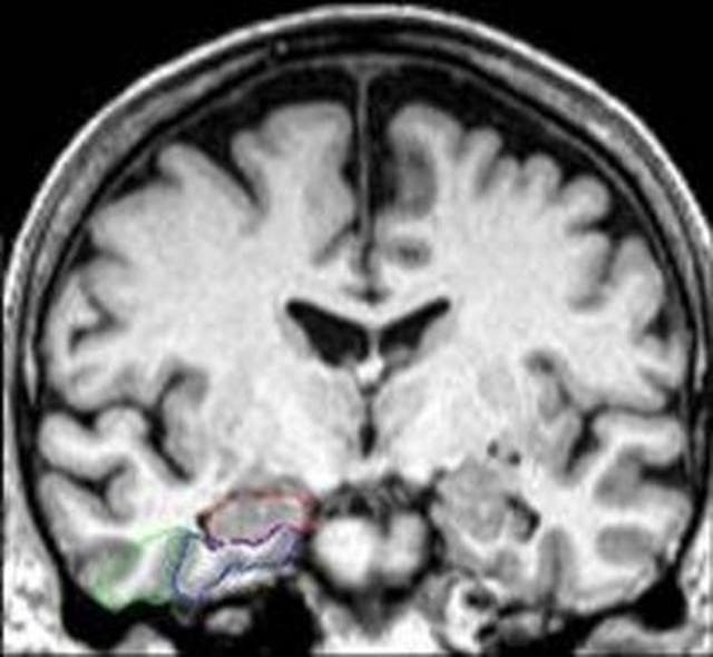<p>MRI brain depicts areas of interest in the brain's medial temporal lobe: hippocampus (outlined in red), entorhinal cortex (blue), and perirhinal cortex (green)</p>