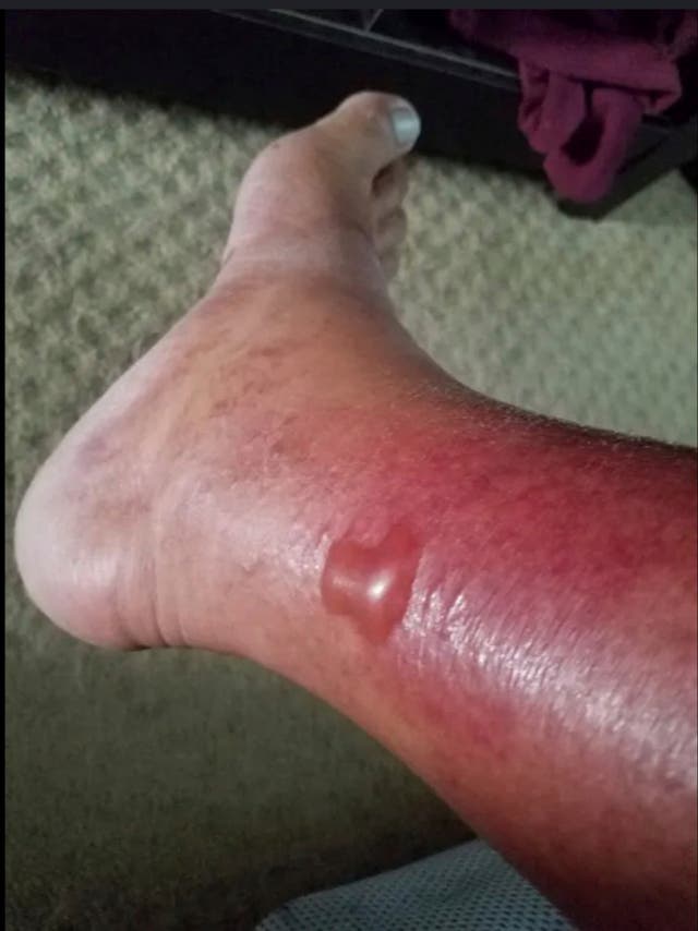 <p>The leg of Bernie Stewart, in Pensacola, Fla., with a blister at the start of an August 2019 Vibrio infection, and years after decaying tissue was surgically removed</p>