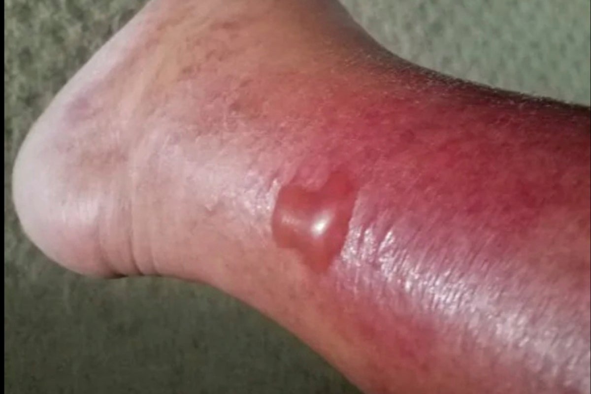 What is Vibrio vulnificus? Symptoms explained as beachgoers warned about flesh-eating bacteria