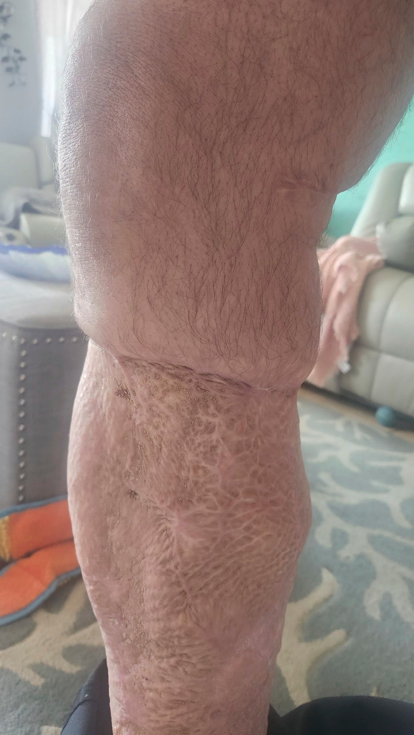 Mr Stewart with skin grafts decaying tissue was surgically removed