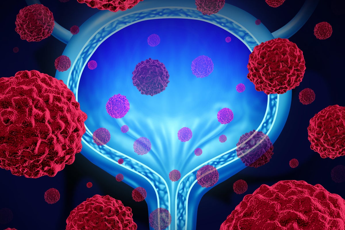 The five bladder cancer warning signs as new NHS treatment approved