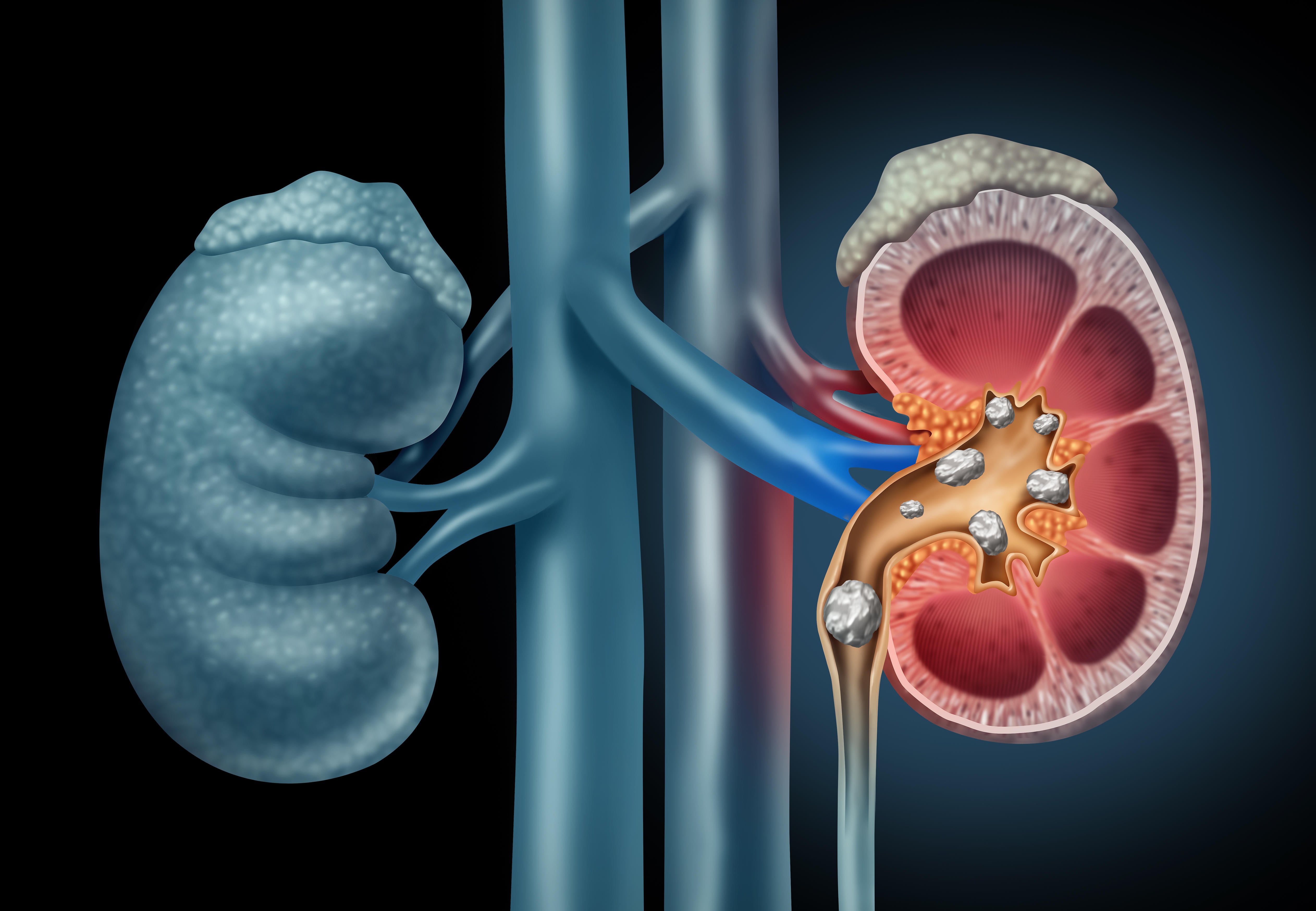 Persistent dehydration can raise the risk of kidney stones over time