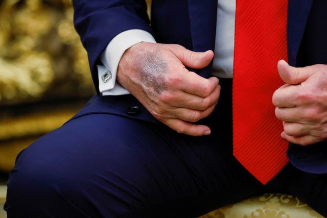 <p>Se observa un hematoma en una mano del presidente de EE. UU., Donald Trump, durante una reunión con el presidente de Corea del Sur, Lee Jae Myung, en la Oficina Oval, en la Casa Blanca; Washington, D. C., EE. UU., 25 de agosto de 2025</p>