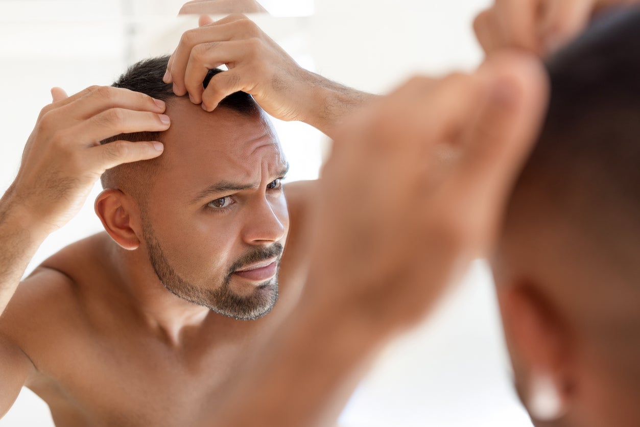 Some 85 percent of American men and 33 percent of women will live with some form of hair loss. A quarter of men start to lose their hair by age 30