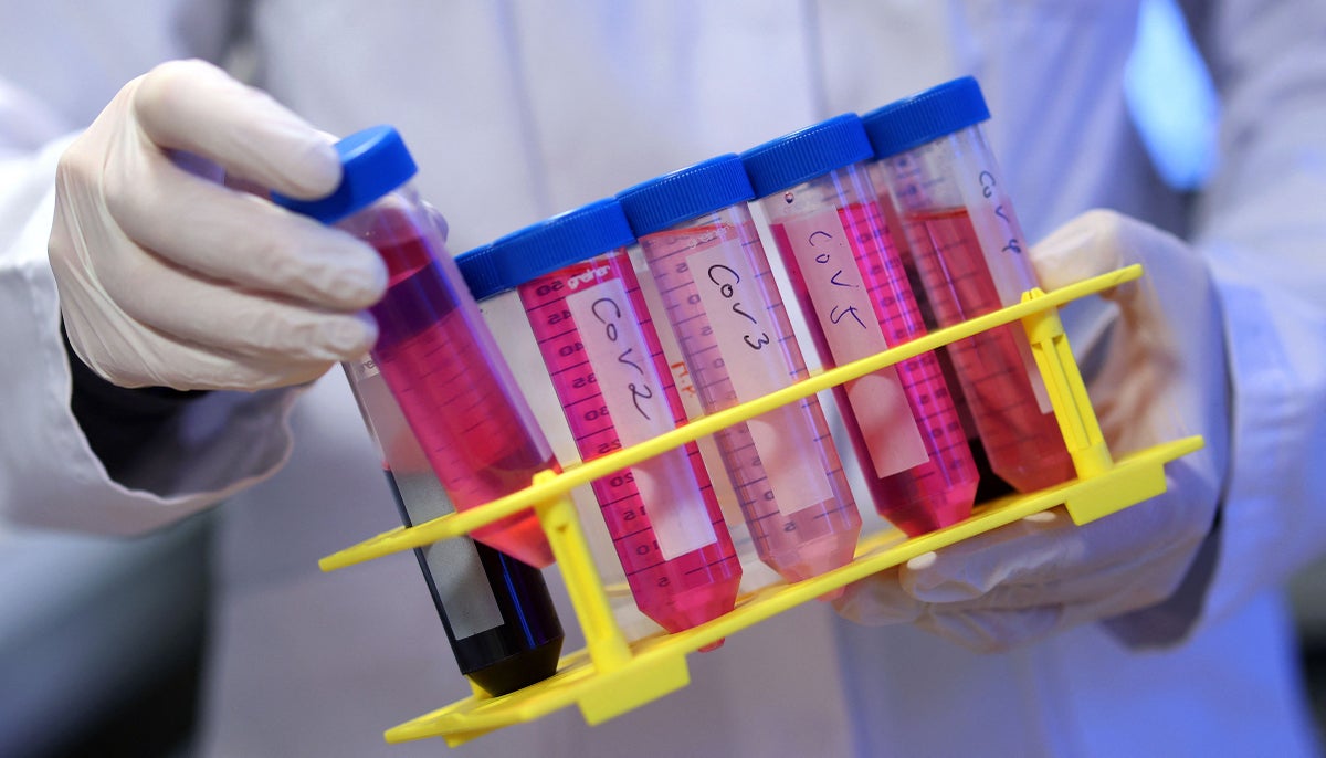 Long Covid could trigger changes in the brain that are similar to Alzheimer’s, new study says