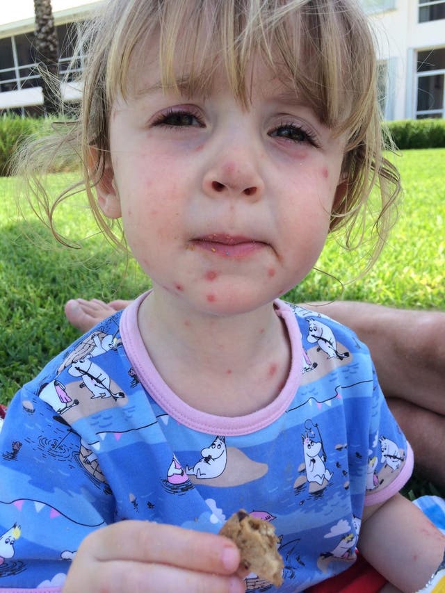 <p>Victoria Richards’ daughter was three when she came out with a few spots on a family holiday – at first, nobody was fazed. But then they got worse</p>