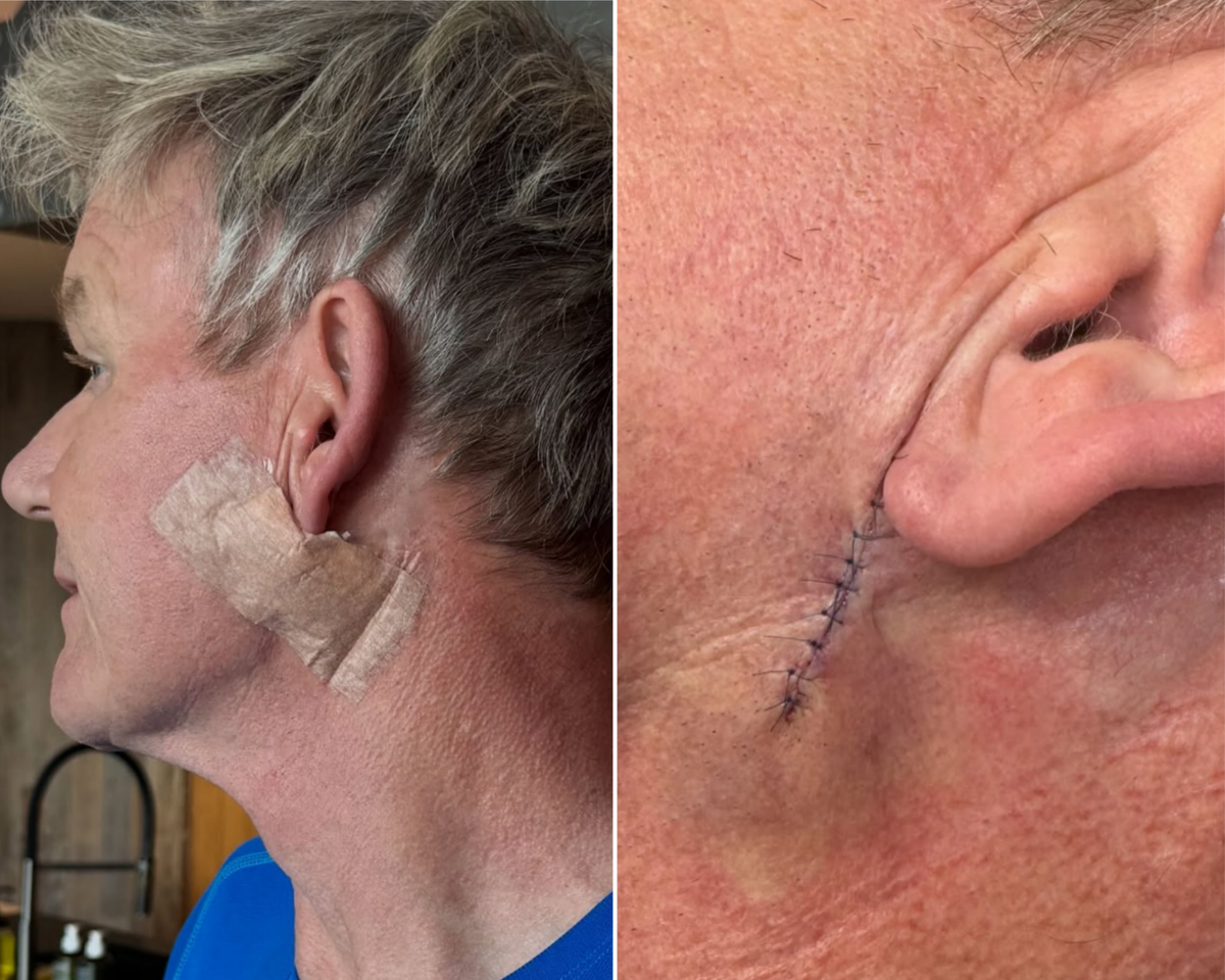 Gordon Ramsay reveals skin cancer scare after undergoing treatment to  remove basal cell carcinoma | The Independent