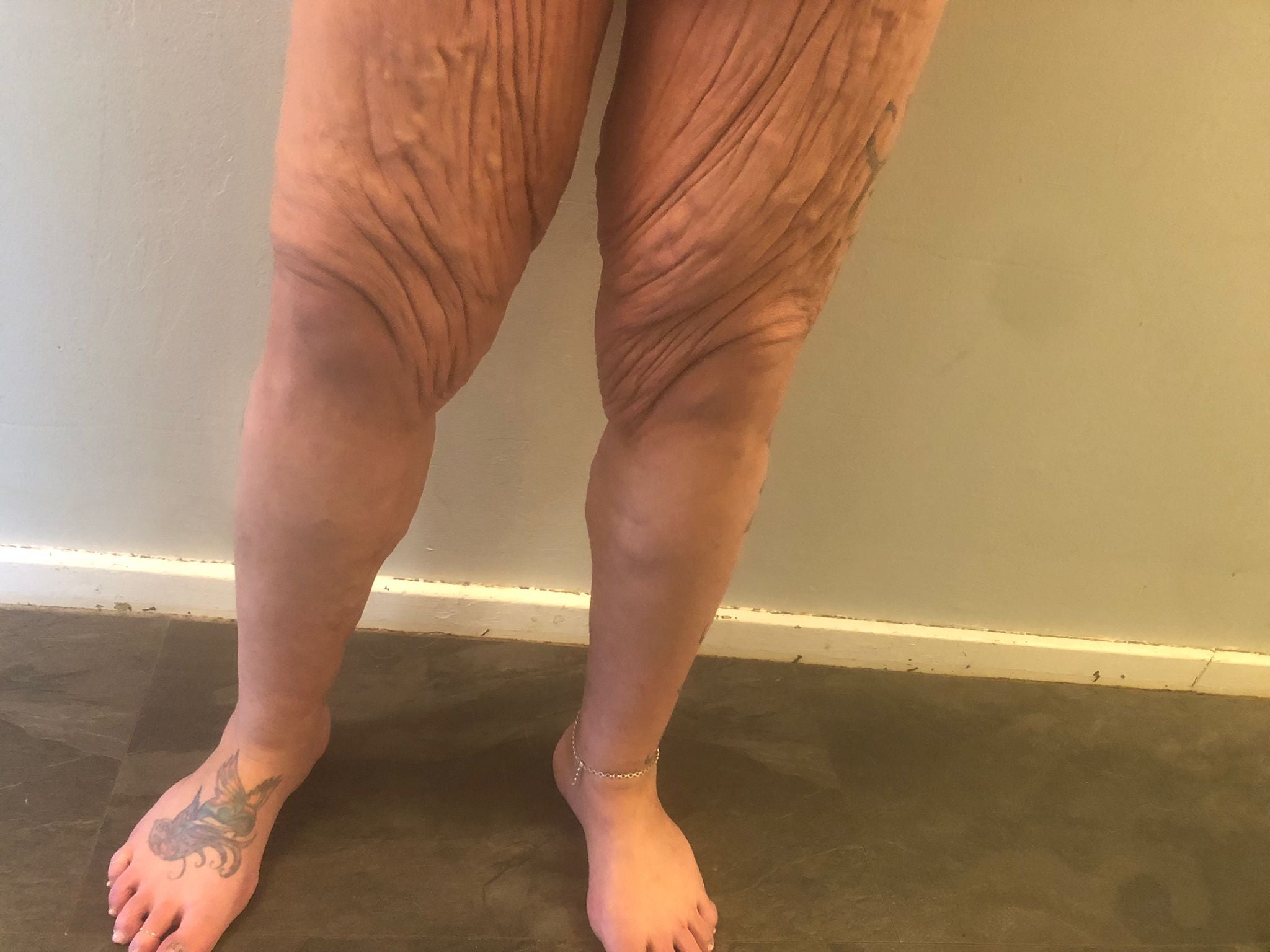 Ms Pryor now has a lot of loose skin on her body. She is hoping to pay for skin removal surgery through fundraising