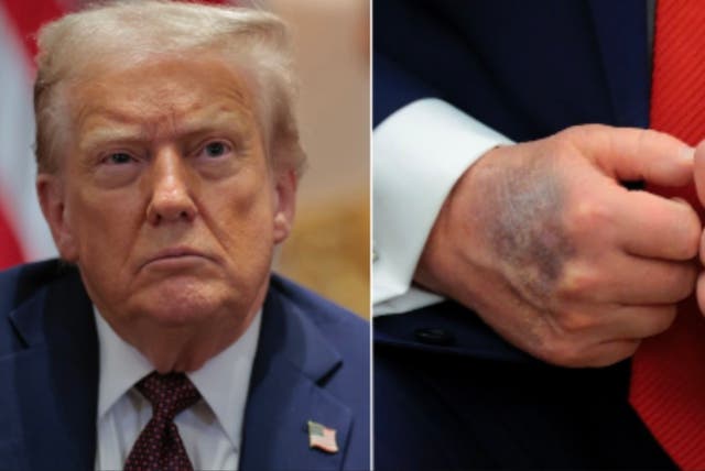 <p>America is split on whether Donald Trump’s health and age are impacting his ability to serve as president, a new poll has found</p>