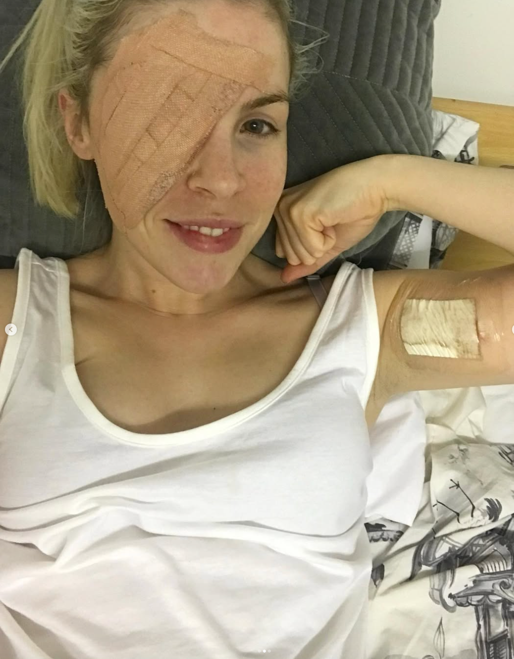 She underwent surgery and required a skin graft from her inner arm to cover up the hole by her eye