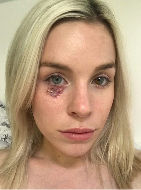She is calling for the VAT on sunscreen to be scrapped as the UK faces an increase in skin cancer rates