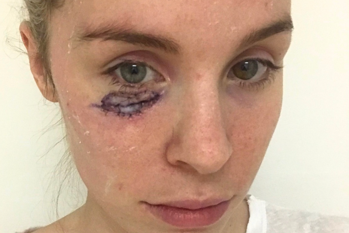 A spot under my eye was skin cancer - VAT on sunscreen needs to be scrapped'