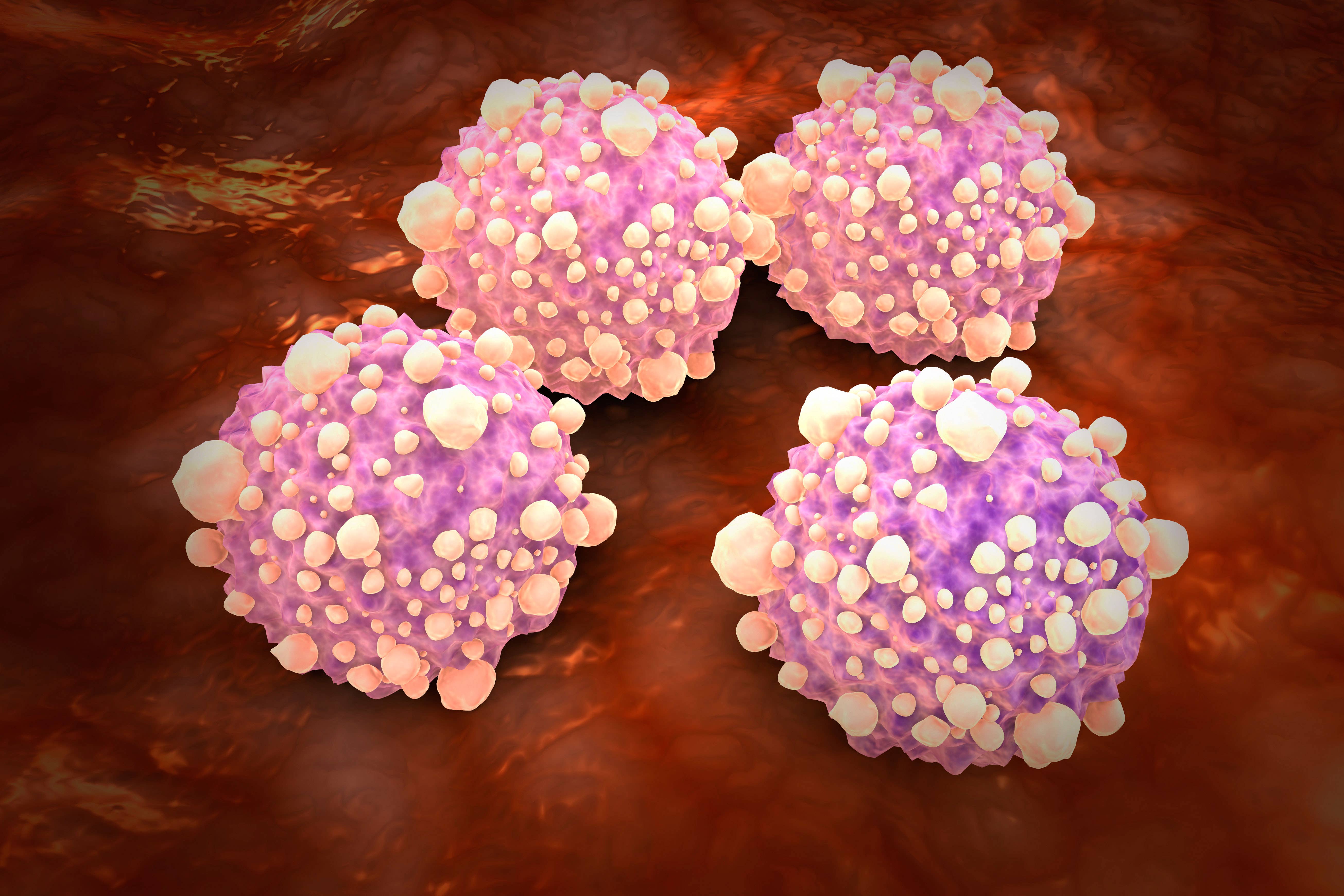 A study has linked 27 types of bacteria and fungi in the mouth with pancreatic cancer