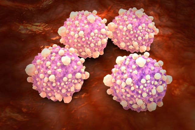 <p>Spotting the cancer in its early stages is key to survival, as more than half of people die within three months of diagnosis</p>