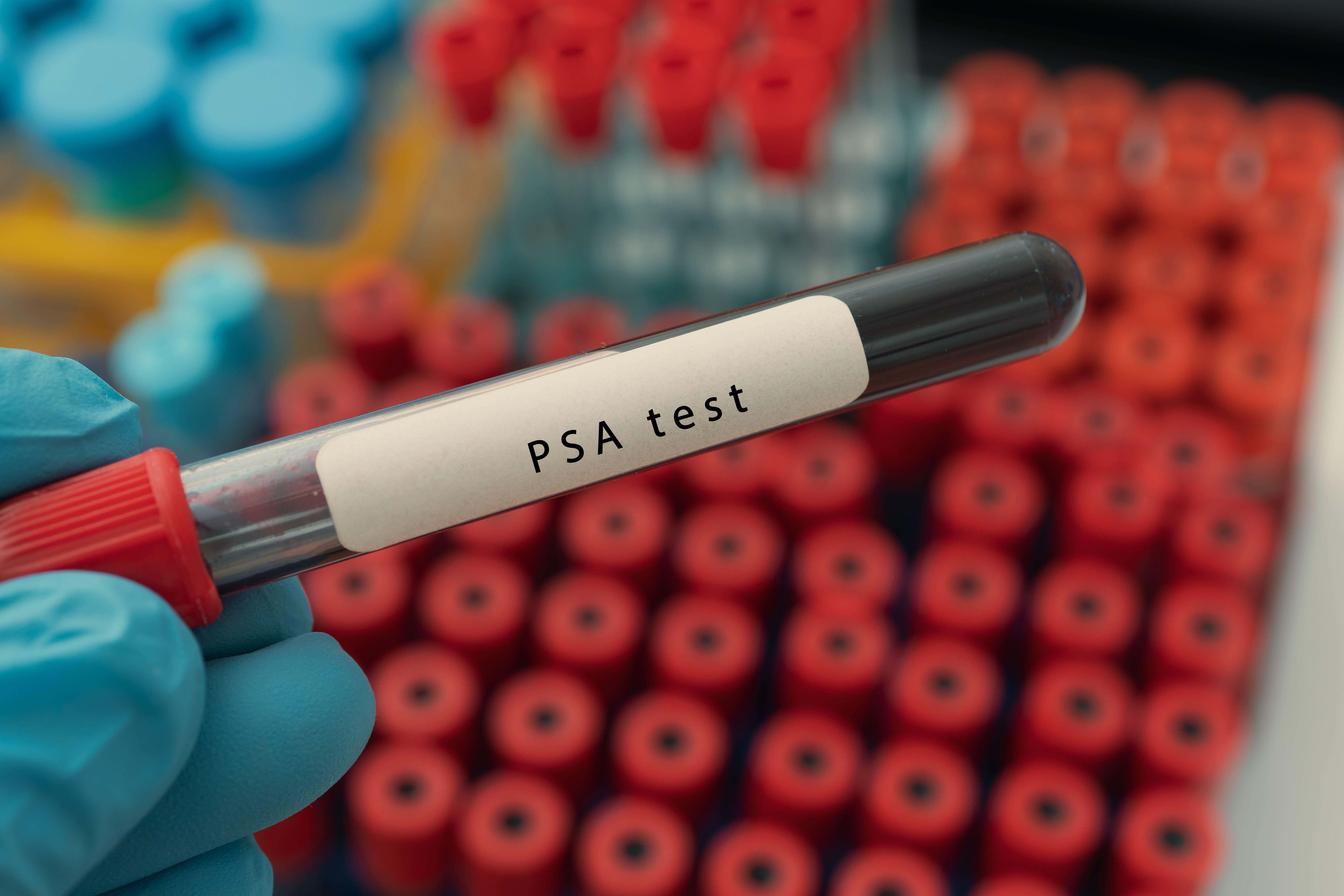 Prostate specific antigen testing (PSA) is only routinely recommended for men with certain symptoms