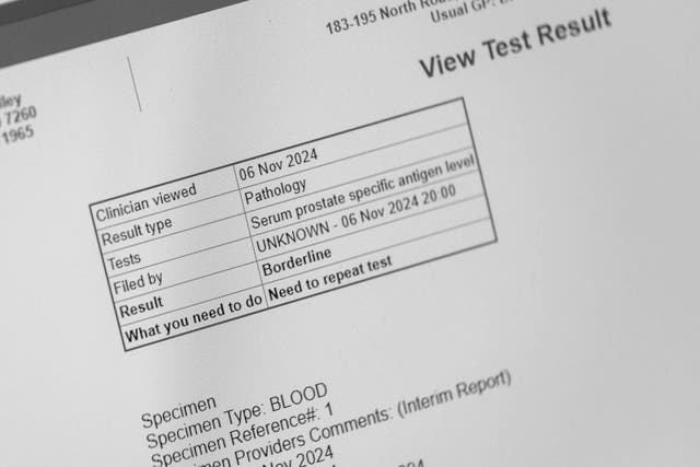 Prostate-specific antigen blood test result on a PC screen. A new study suggests the test can lead to over-treatment and over-diagnosis. Alamy/PA.
