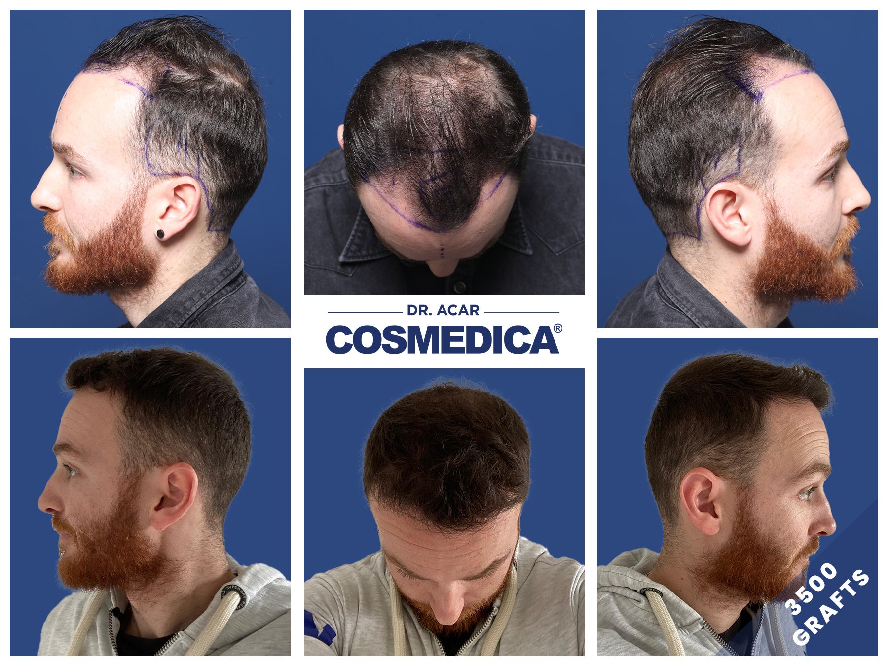 Before and after results of a hair transplant at Cosmedica Clinic