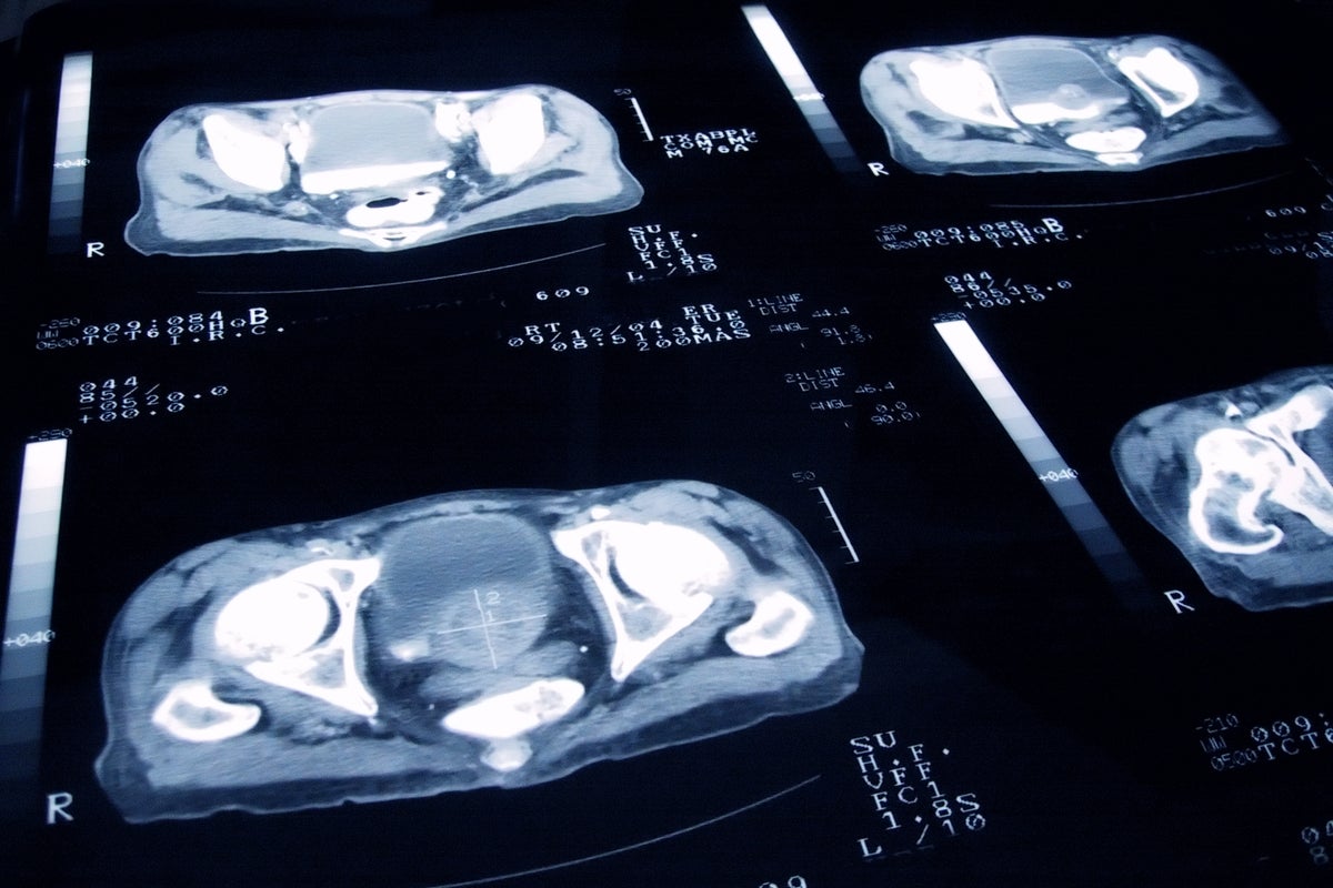 Widespread prostate cancer screening could soon become a reality
