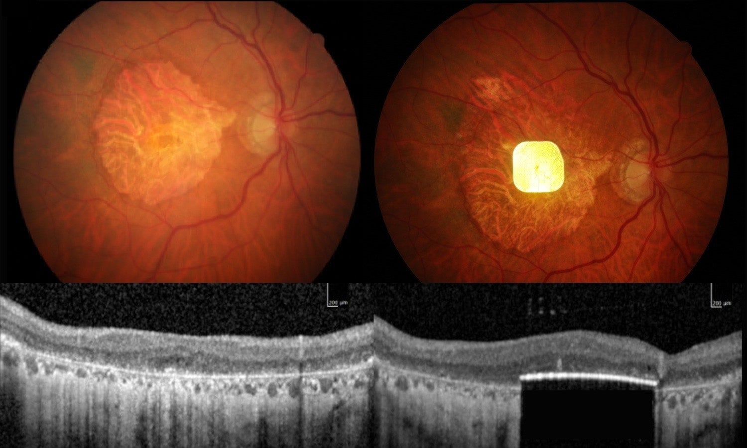 The device electronically bypasses the retina to send visual signals directly to the brain via the optical nerve