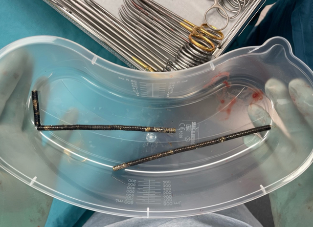 <p>About 80 to 100 high-powered magnets retrieved from operation</p>