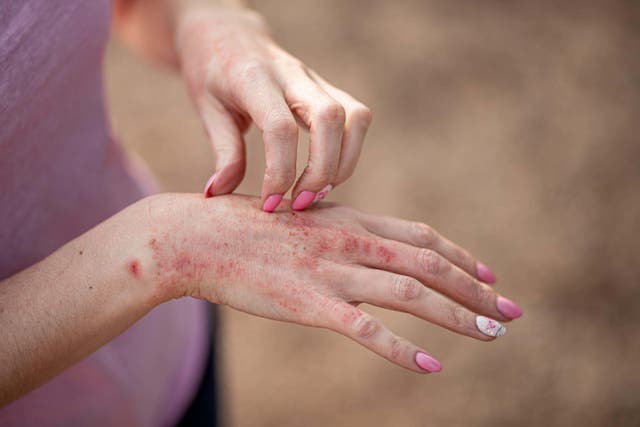 Hand eczema causes the hands to become dry, sore, cracked and itchy (Alamy/PA)