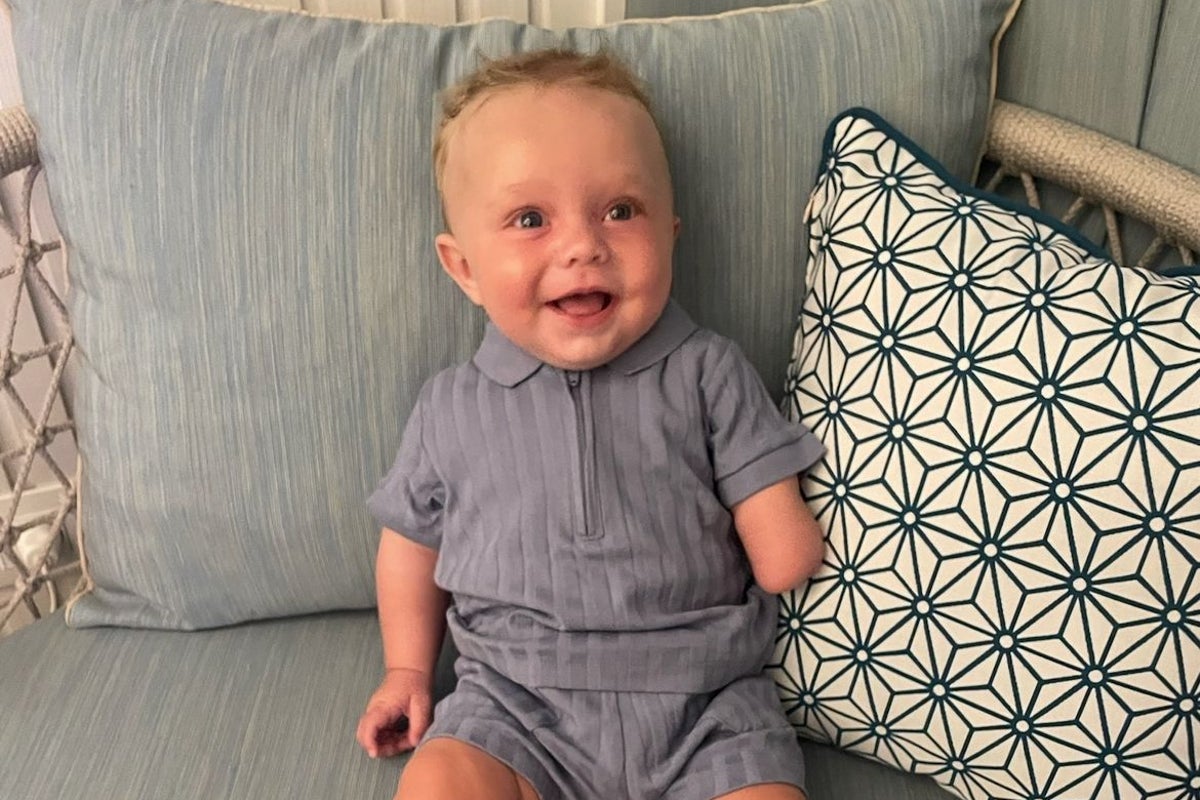 Baby boy’s hand severed in utero due to extremely rare condition Baby boy’s hand severed in utero due to extremely rare condition